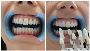 Laser Teeth Whitening Dentist Near Me in NYC