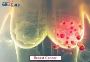 Comprehensive Breast Cancer Care with EdhaCare