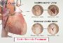 Aortic Stenosis Treatment in India with EdhaCare
