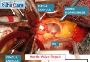  Expert Aortic Valve Repair in India with EdhaCare