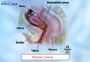 Uterine Cancer Treatment in India with EdhaCare