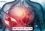 Affordable Atherosclerosis Treatment in India – Expert Care 