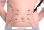 Liposuction in India | Best Clinics & Affordable Cost – Edha