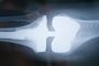 Discover the Benefits of Joint Replacement Surgery in India