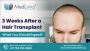 3 Weeks After a Hair Transplant: What You Should Expect?|  H