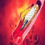 Coronary Artery Disease Treatment