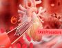 TAVR Procedure in India