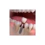 Permanent Tooth Replacement with Dental Implants in Ontario
