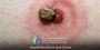 Get Natural Remedies for Managing Lyme Disease Symptoms