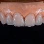 Emax Porcelain Crowns Supplier for Dental Labs