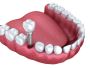 Transform Your Smile with Dental Implants in Brampton