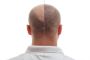 Best Hair Transplant Clinic in Delhi