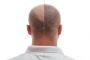 Dr. A’s Clinic-- Hair Transplant Cost in Delhi