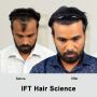 Hair transplant in Jodhpur