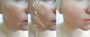 Botox Treatment in Kolkata – Smooth, Youthful & Natural Resu