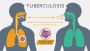Tuberculosis (TB) Symptoms and Treatment