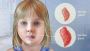 Mumps - Causes And Symptoms