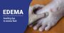 What Is Edema - Symptoms and Causes