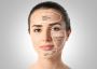 Acne Treatment – Clear Skin, Renewed Confidence
