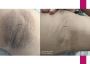 Dark Underarms Treatment – Restore Your Skin’s Confidence