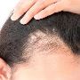 Checkout the Best Women's Hair Fall Treatment Perth
