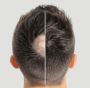 Seamless Integrated Hair System from Hair Fall Treatment AU