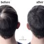 Best Hair Replacement System in Yorba Linda