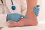 Effective and Safe Treatments for Varicose Veins