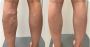 Quick & Effective Treatments for Varicose Veins