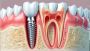 Best Dental Implant Clinic in Nagerbazar