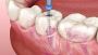 The Best Root Canal Therapy Center in Dum Dum Nagerbazar