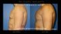 Transform Your Physique with Pec Implants