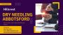 Dry Needling Abbotsford - Hillcrest