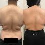 Best Fat Reduction treatment in Mount Lawley