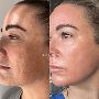 Best Dermal Filler treatment in Page