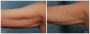 Find the best Cellulite treatment in the McDonough