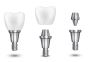 Dental Implant Cost in India