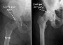 Hip Arthritis Pain Management in Kota at Trusted Clinic