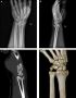 Advanced Intra-Articular Fracture Treatment and Care in Kota