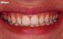 Teeth Filling Services at Clarity Dental for a Healthy Smile