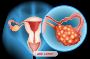 Anal Cancer Treatment