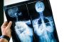 Brain Injury Lawyer in Seattle Brain Injury Lawyer in Seattle