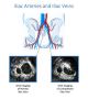 May-Thurner syndrome in Tampa Florida