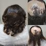 Hair Loss Treatment Starts Here! Contact Hair Clinique Resto