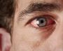 Best Bloodshot Eyes Treatment in Delhi - Goyal Eye