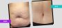 Tummy Tuck Surgery in Gurgaon