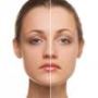 Effective and Affordable Laser Hair Removal in Surrey and We