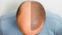 Hair Transplants in Dubai: Restore Hair with Lasting Results