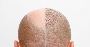 Unlocking Confidence: A Guide to Hair Transplants in Dubai