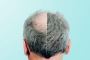 Hair Transplant Cost: Why It’s Higher—and If It’s Worth the 